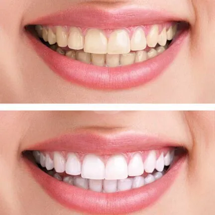 Kosmetisches Zahnbleaching