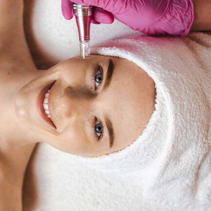 RF Microneedling Behandlung